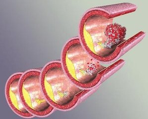 如何防止動脈硬化的發生呢?