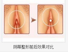 陰蒂整形的注意事項有哪些
